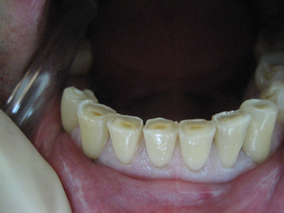 Фото патологического стирания зубов