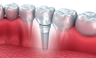 Фото классической имплантации зубов