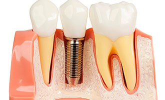 Осложнения во время установки зубных имплантов - фото