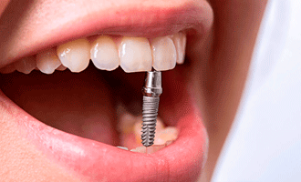 Имплантация зубов в Железнодорожном