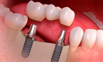 несъемное протезирование зубов на имплантах в Железнодорожном